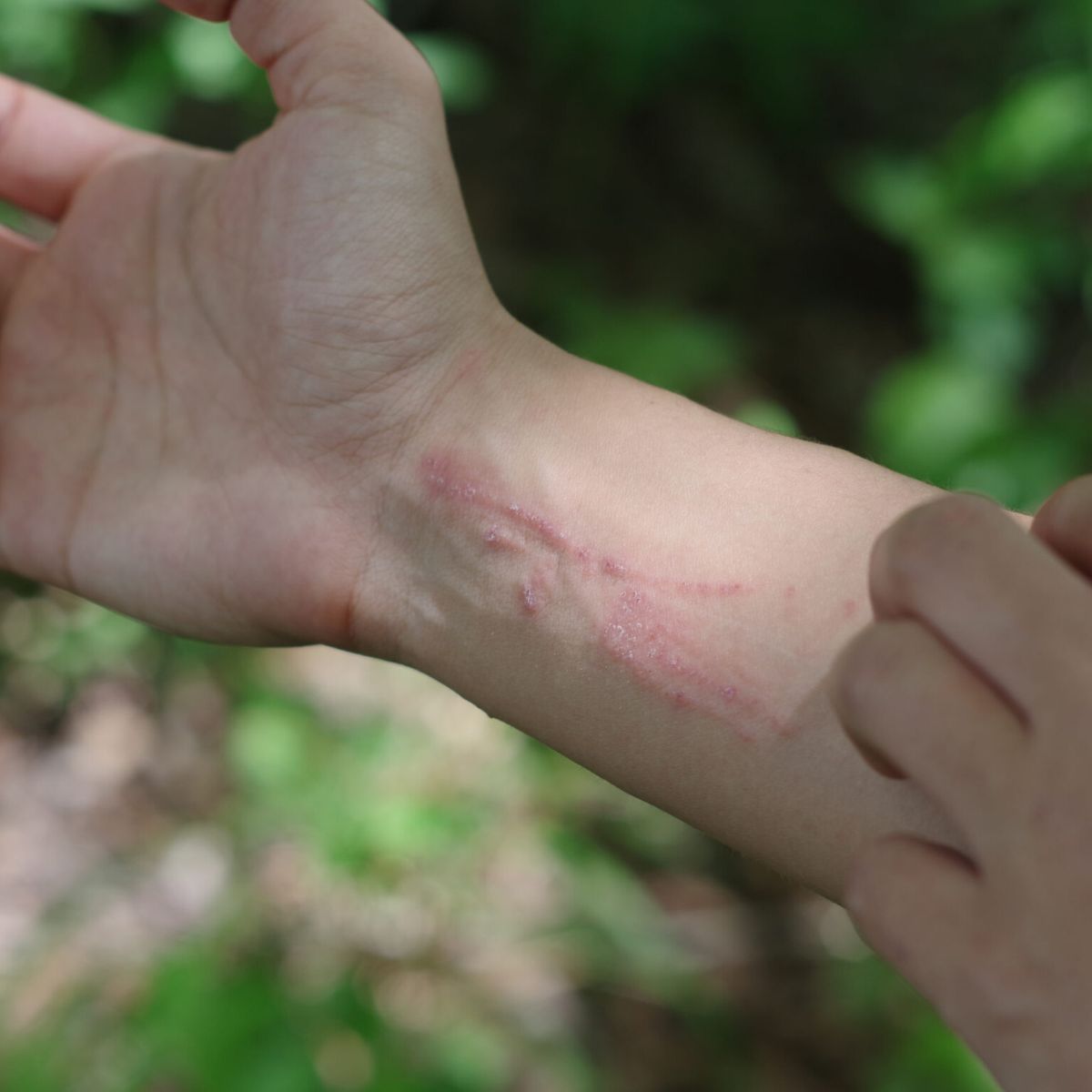 Poison Ivy skin rash on Thursd